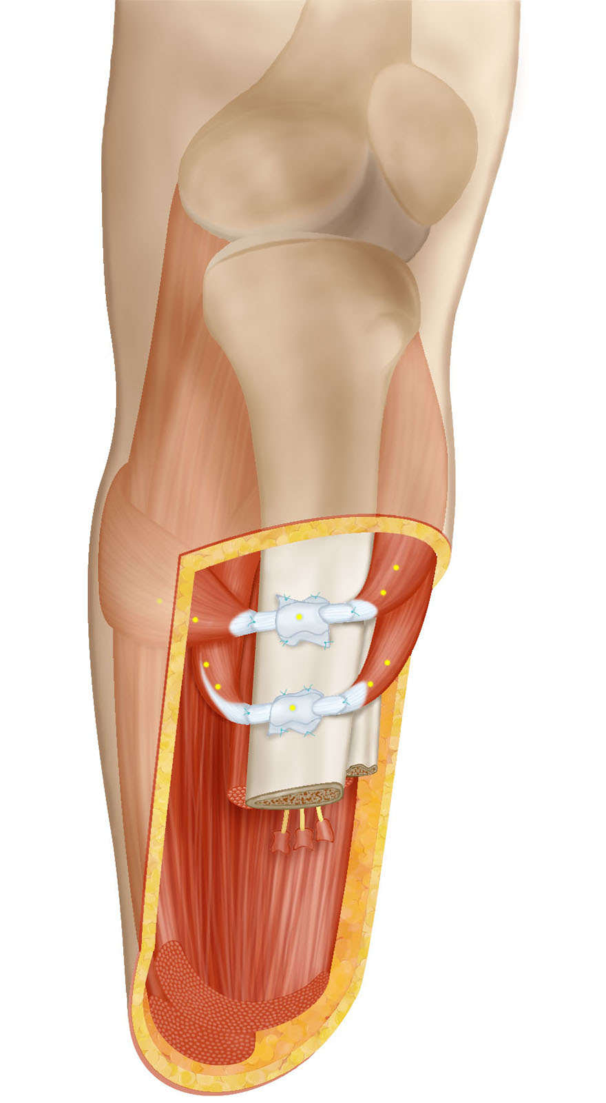 Ewing Amputation surgical illustration